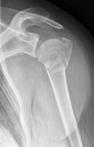 Proximaler Oberarmbruch5