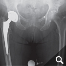 Infizierte Hüfttotalendoprothese